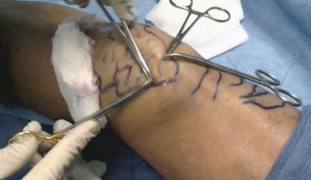 Chirurgie pour les varices