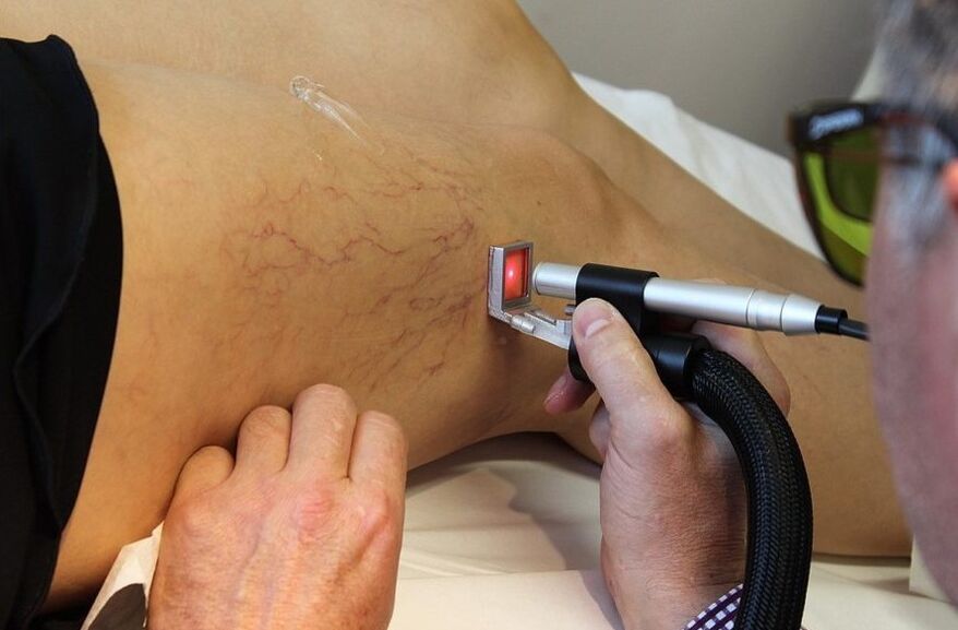Rayonnement laser