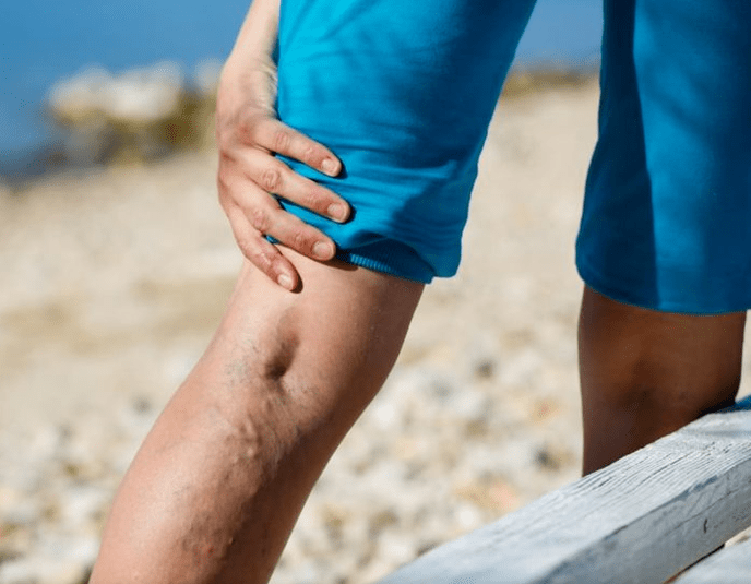 Causes de varices chez les femmes