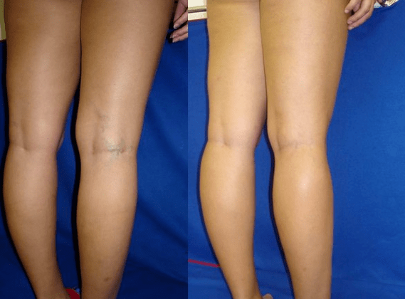 Causes internes des varices