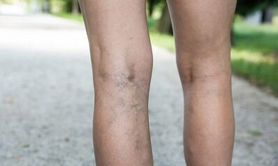Les raisons du développement des varices chez les femmes