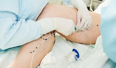 Méthodes de traitement des varices sur les jambes chez les femmes