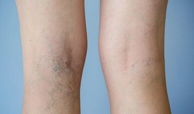 Signes de varices sur les jambes chez les femmes