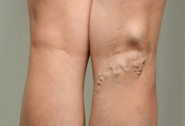 Diagnostic des varices chez la femme enceinte