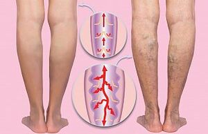 varices des membres inférieurs
