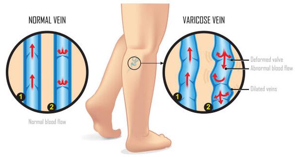 varices des membres inférieurs