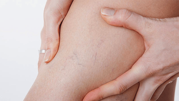 varices sur les jambes