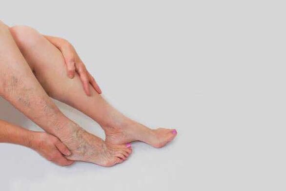 Les veines dilatées saillantes sont le signe de varices des membres inférieurs