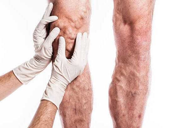 Palpation des varices sur les jambes