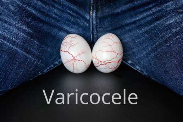 Varicocèle - dilatation des veines du cordon spermatique